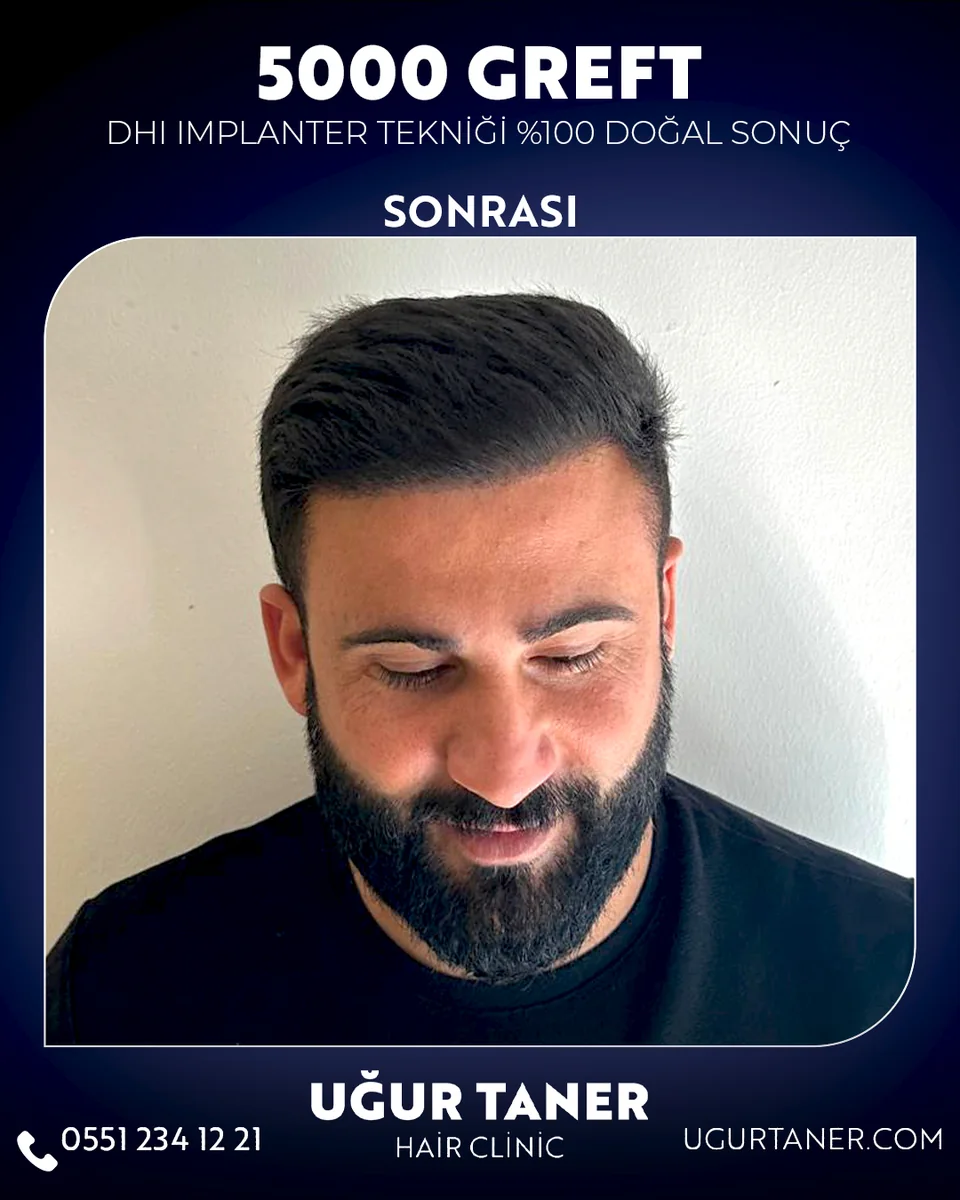 Uğur Taner Hair Clinic saç ekimi planlaması