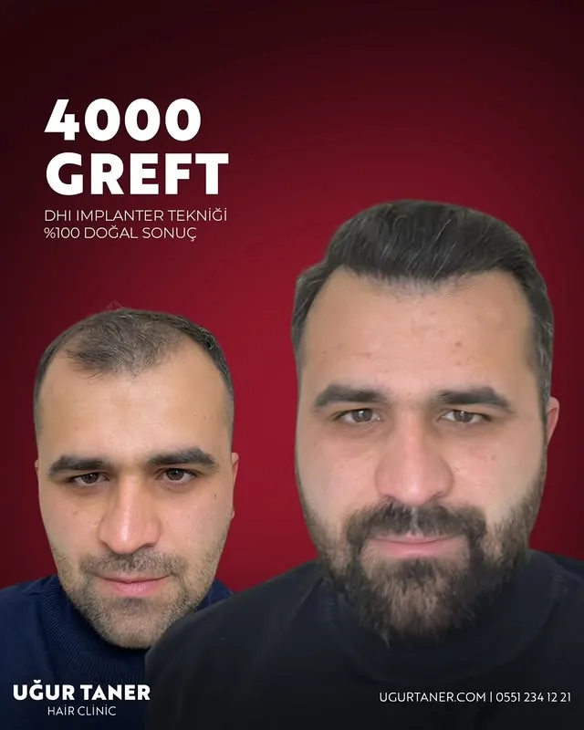 ✨ 4000 Greft, DHI İmplanter Tekniği ile %100 Doğal Sonuç! ✨ Saç ekiminde en yeni teknolojiyle, doğal