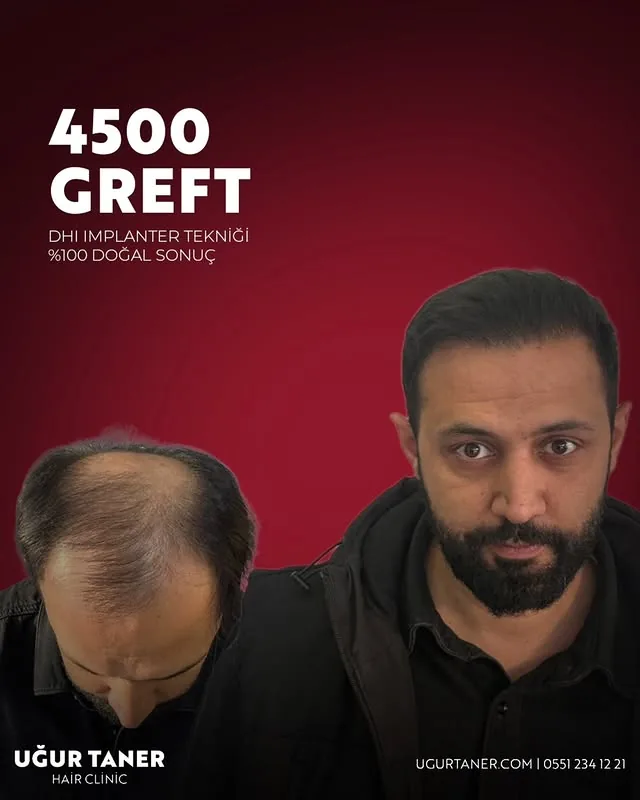 ✨ 4500 Greft, DHI İmplanter Tekniği ile %100 Doğal Sonuç! ✨ Saç ekiminde en yeni teknolojiyle, doğal