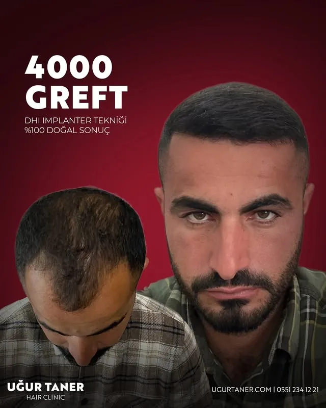 ✨ 4000 Greft, DHI İmplanter Tekniği ile %100 Doğal Sonuç! ✨ Saç ekiminde en yeni teknolojiyle, doğal