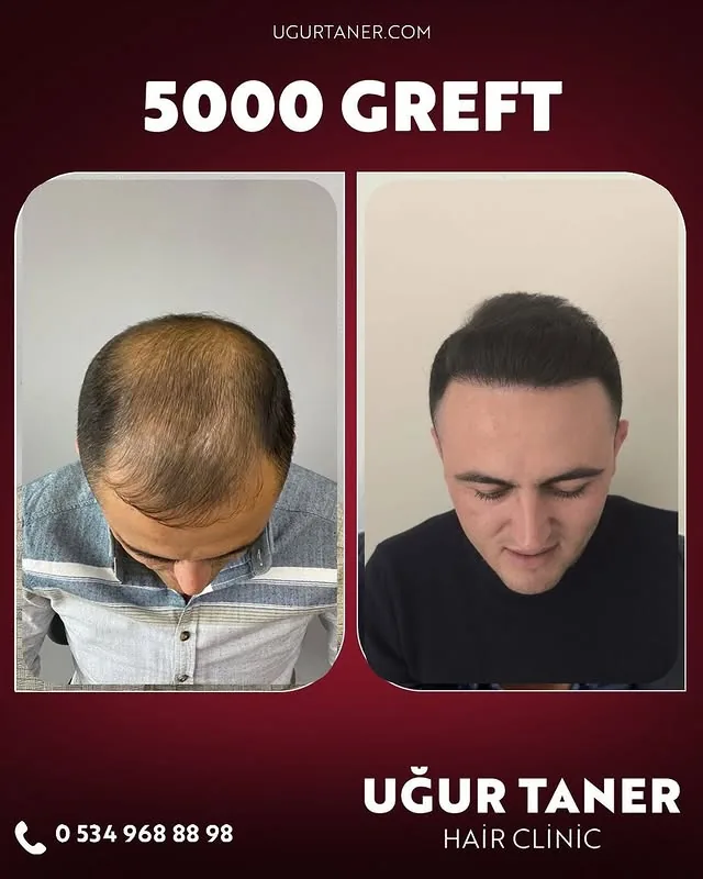 ✨5000 greft✨DHİ İmplanter tekniği ile %100 doğal ve yoğun saçlar!✨ Saç ekiminde en yeni teknoloji il