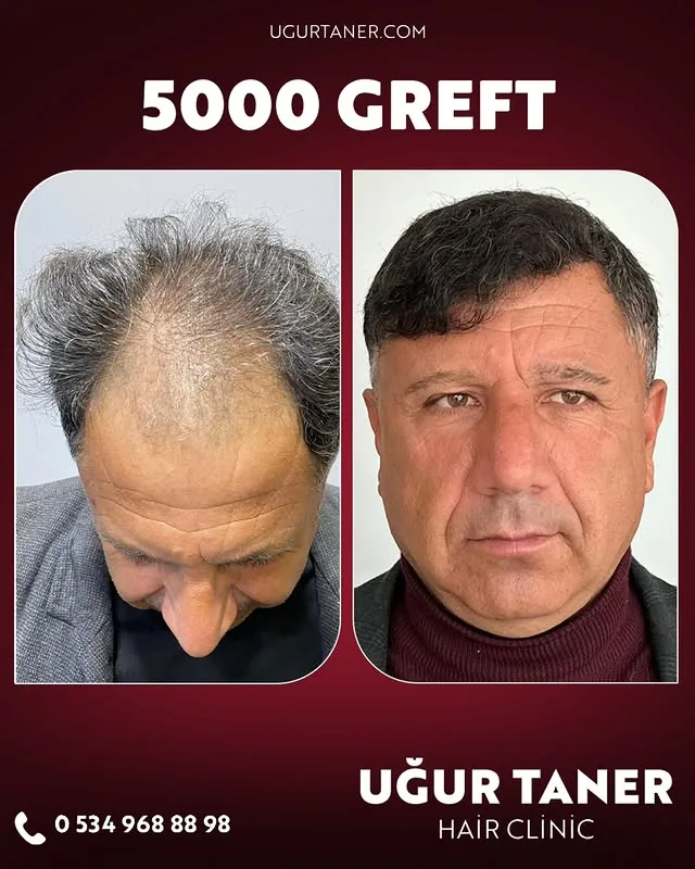 ✨ 5000 Greft, DHI İmplanter Tekniği ile %100 Doğal Sonuç! ✨ Saç ekiminde en yeni teknolojiyle, doğal