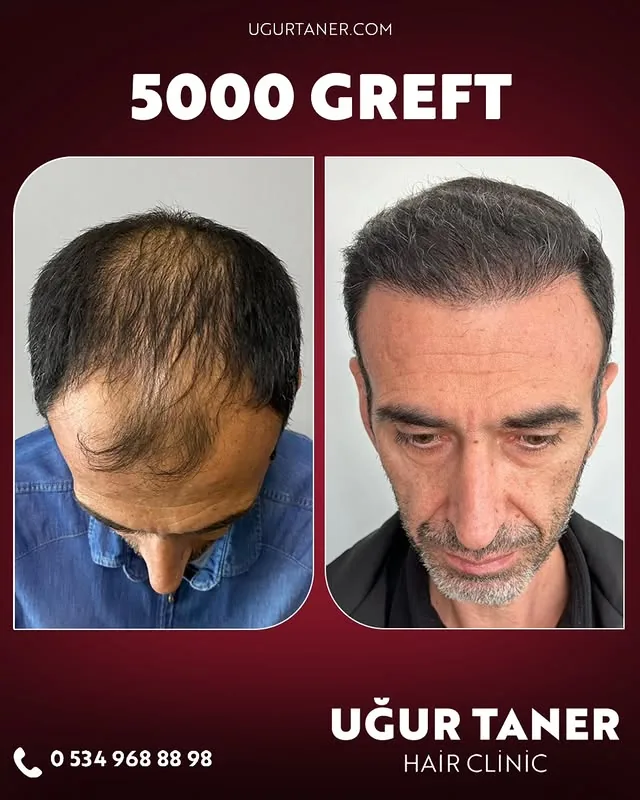 ✨ 5000 Greft, DHI İmplanter Tekniği ile %100 Doğal Sonuç! ✨ Saç ekiminde en yeni teknolojiyle, doğal