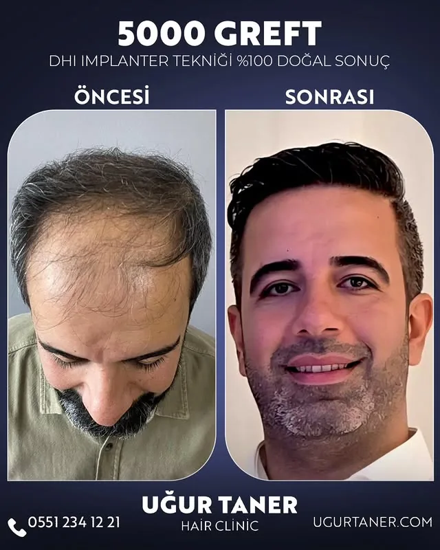 ✨ 5000 Greft, DHI İmplanter Tekniği ile %100 Doğal Sonuç! ✨ Saç ekiminde en yeni teknolojiyle, doğal