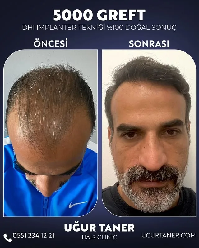 ✨ 5000 Greft, DHI İmplanter Tekniği ile %100 Doğal Sonuç! ✨ Saç ekiminde en yeni teknolojiyle, doğal