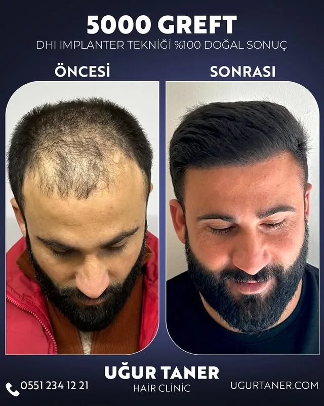 5000 greft DHI saç ekimi vaka paylaşımı – Uğur Taner Hair Clinic Instagram