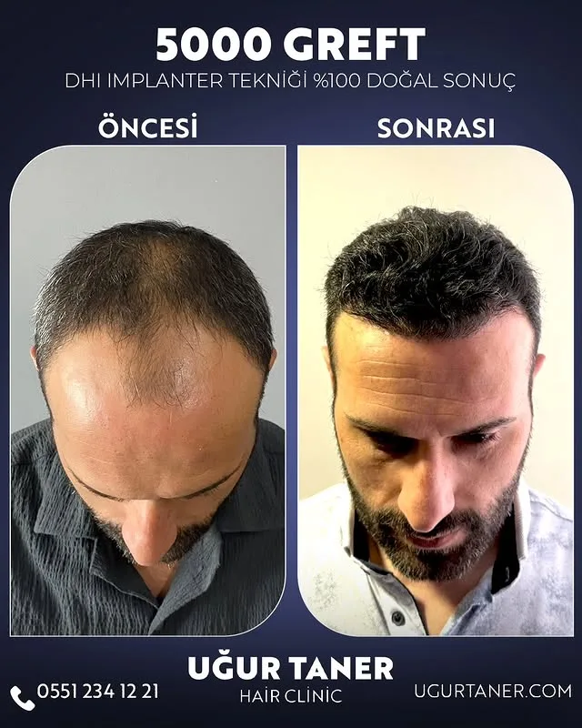 5000 greft DHI saç ekimi vaka paylaşımı – Uğur Taner Hair Clinic Instagram