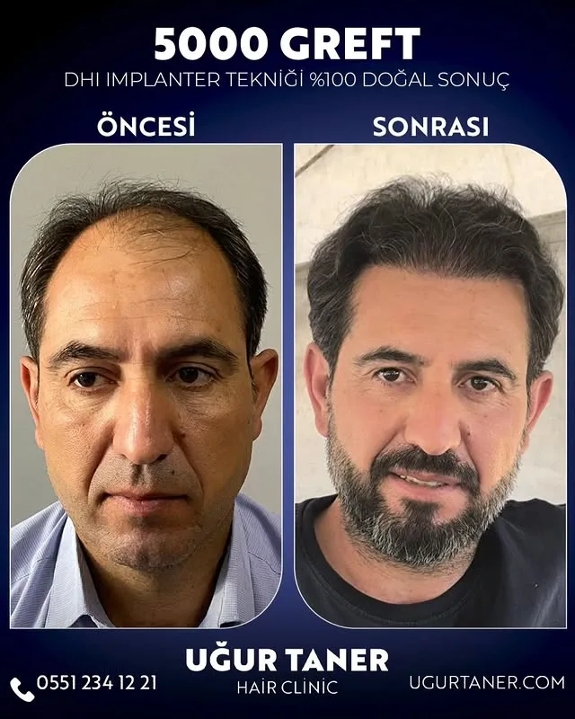 5000 greft DHI saç ekimi vaka paylaşımı – Uğur Taner Hair Clinic Instagram