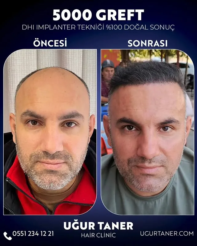 5000 greft DHI saç ekimi vaka paylaşımı – Uğur Taner Hair Clinic Instagram